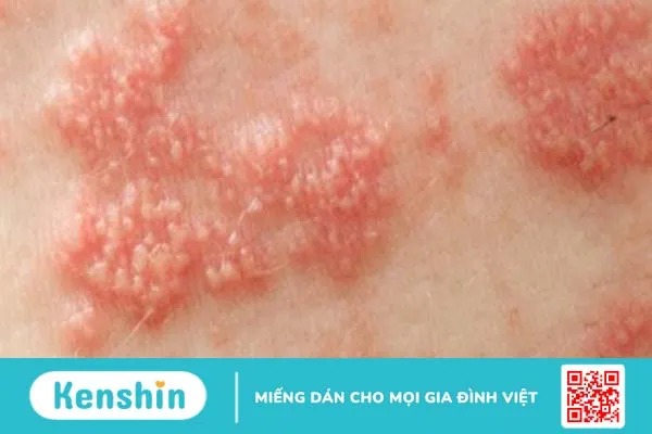 Quá trình lupus ban đỏ thường xuất hiện triệu chứng nào?