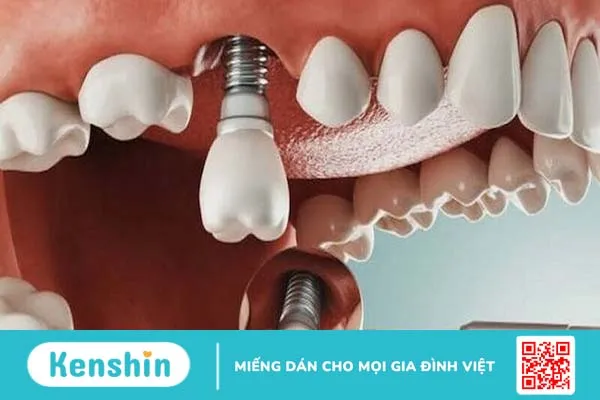 Quy trình trồng răng Implant như thế nào? Những thông tin cần biết