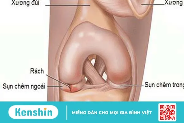 Rách sụn chêm bao lâu thì khỏi? Cần chú ý điều gì khi thực hiện các bài tập phục hồi chức năng?