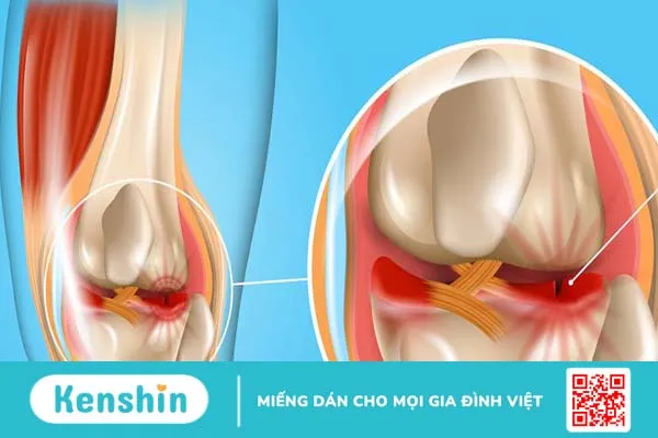 Rách sụn chêm: Dấu hiệu, nguyên nhân và hướng điều trị