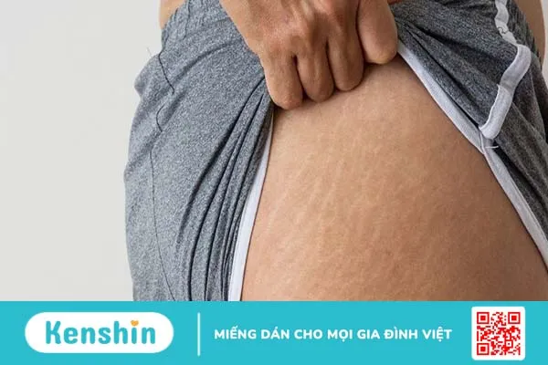 Rạn da mông ở nam: Tìm hiểu nguyên nhân và cách điều trị