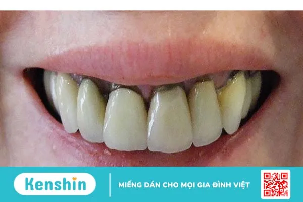 Răng có vết đen: Nguyên nhân và cách khắc phục