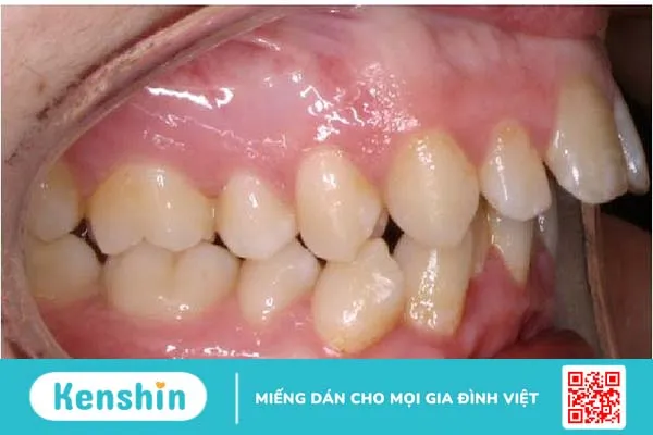 Răng lồi xỉ là gì? Nguyên nhân và cách điều trị