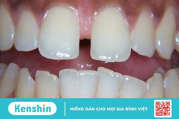 Răng sinh đôi: Nguyên nhân và cách khắc phục hiệu quả