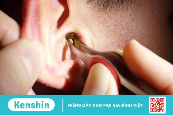 Ráy tai là gì, màu sắc ráy tai biểu thị bệnh lý gì?