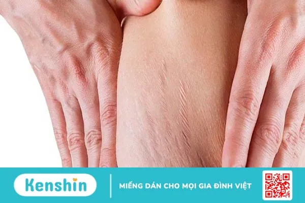 Review kem trị rạn da sau sinh “hot” nhất trong giới mẹ bỉm