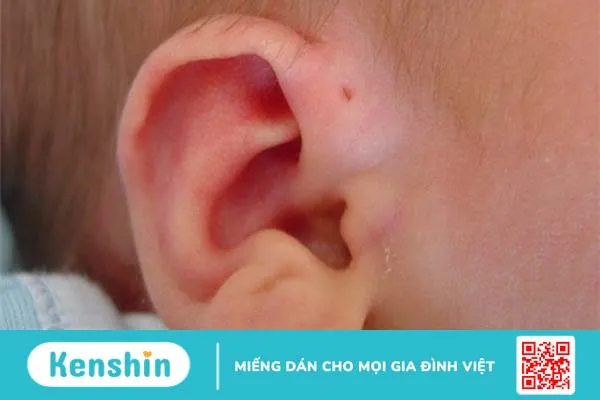 Rò luân nhĩ vệ sinh như thế nào? Các phương pháp điều trị