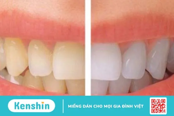 Sau khi tẩy trắng răng nên ăn gì, kiêng gì?