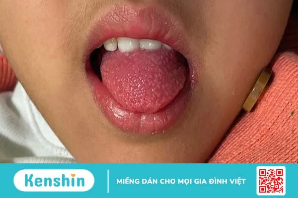 Scarlet fever là gì? Nguyên nhân, triệu chứng, chẩn đoán và điều trị Scarlet fever