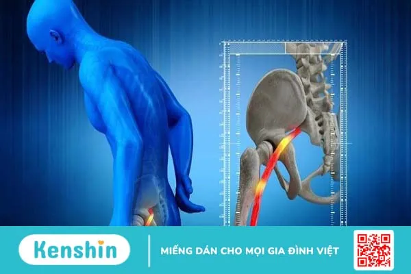 Sciatic nerve là gì? Nguyên nhân, triệu chứng và các phương pháp điều trị