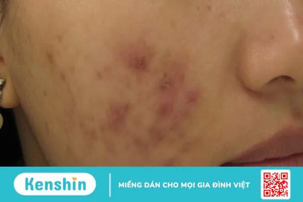 Sẹo lồi sau mụn: Nguyên nhân và cách điều trị