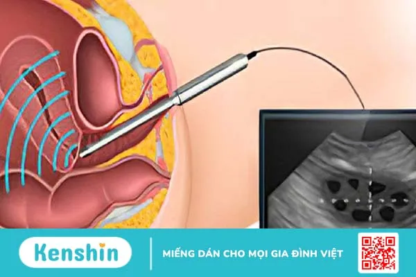 Siêu âm đầu dò: Những điều bạn cần biết