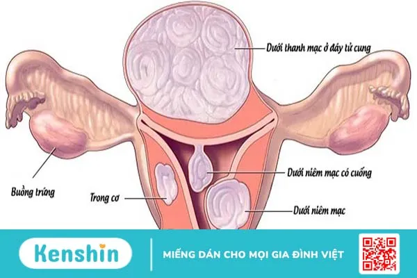 Sự nguy hiểm của tình trạng u xơ tử cung bị vôi hóa