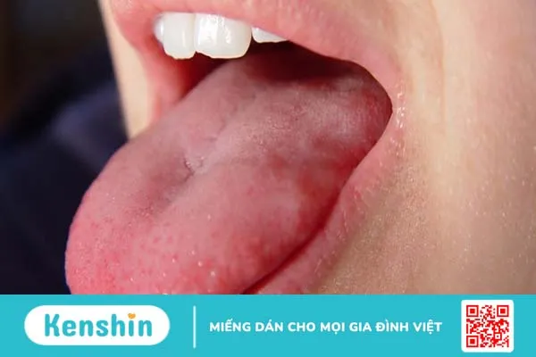 Sưng lưỡi là bệnh gì? Nguyên nhân và cách điều trị