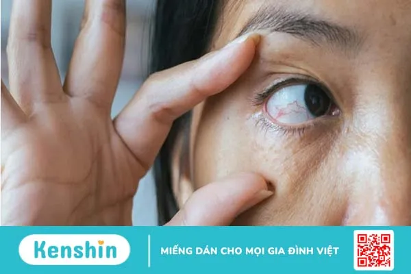 Tắc tĩnh mạch trung tâm võng mạc: Nguyên nhân, cách điều trị và phòng ngừa