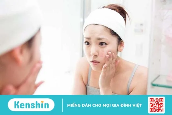 Tại sao mụn cứ nổi hoài?