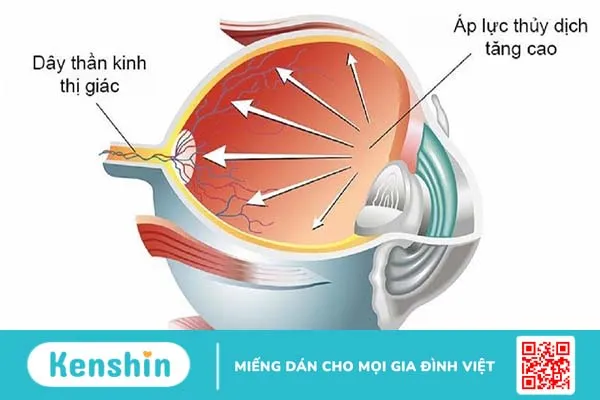 Tăng huyết áp mắt: Nguyên nhân và cách điều trị