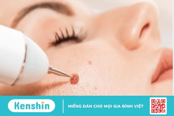 Tẩy nốt ruồi có ăn được thịt lợn không?