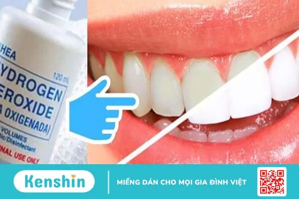 Tẩy trắng răng bằng oxy già có những cách nào? Lưu ý khi tẩy trắng răng với oxy già