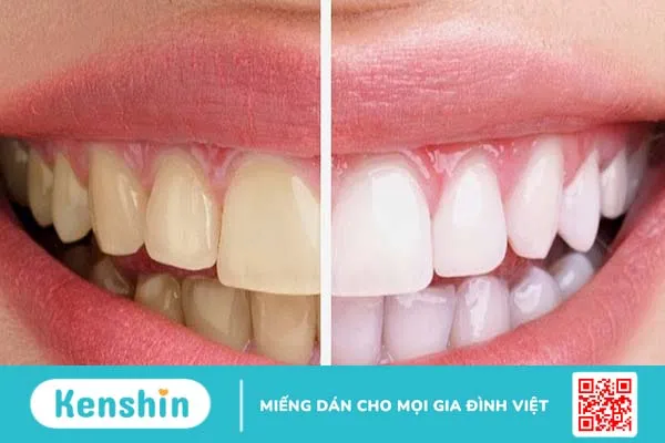 Tẩy trắng răng có bị vàng lại không? Lưu ý cách chăm sóc răng sau khi tẩy trắng