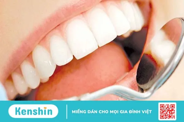 Tẩy trắng răng nhưng răng không đều màu: Nguyên nhân do đâu và cách khắc phục