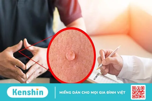 Tham khảo phác đồ điều trị sùi mào gà Bộ Y tế: Chủ động hiểu hơn về bệnh!