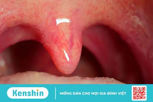 Thế nào là viêm họng lưỡi gà dài? Nguyên nhân, triệu chứng và cách điều trị