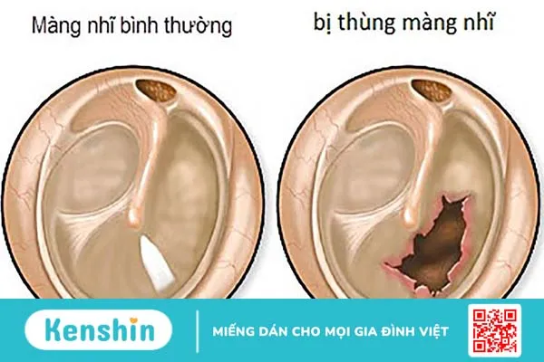 Thủng màng nhĩ có bị điếc không? Các phương pháp điều trị