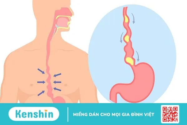 Thủng thực quản là gì? Nguyên nhân và phương pháp điều trị thủng thực quản