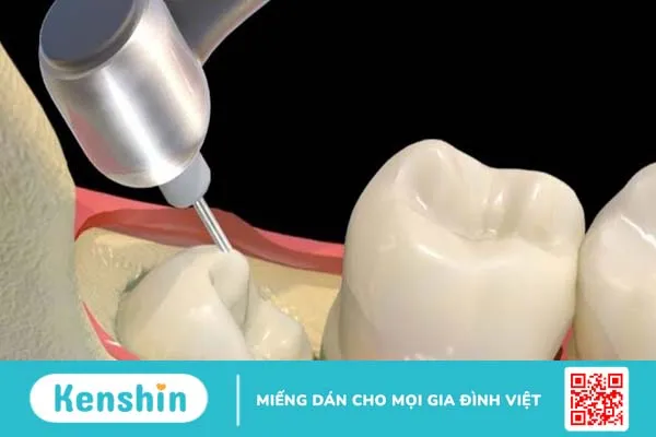 Tiểu phẫu răng khôn và những điều bạn cần lưu ý