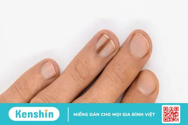 Tìm hiểu móng tay có sọc đen nhỏ là bệnh gì?