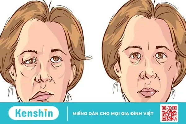 Tìm hiểu tai biến méo miệng do liệt dây thần kinh số 7