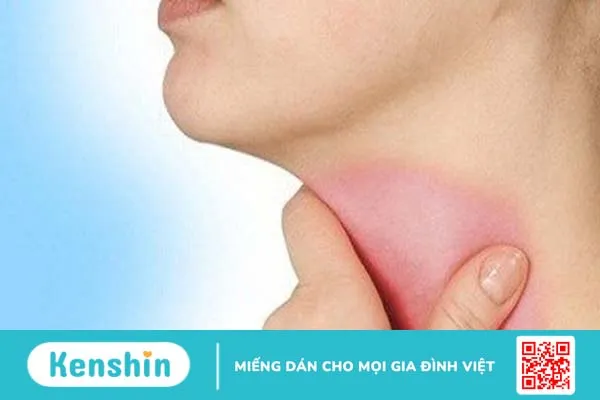 Tìm hiểu về bệnh viêm thanh thiệt là gì? Cách nhận biết và điều trị bệnh