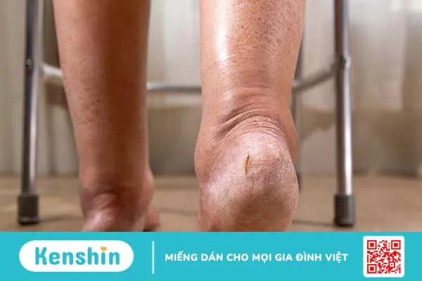 Tìm hiểu về các phân độ phù, nguyên nhân và cách điều trị