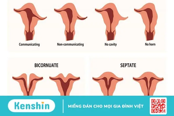 Tìm hiểu về dị dạng sinh dục nữ