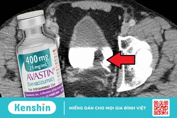 Tìm hiểu về liệu pháp kháng sinh mạch trong điều trị ung thư