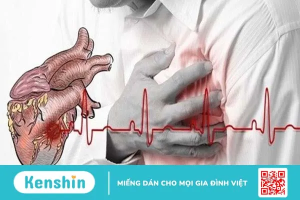 Tìm hiểu về phân độ Killip trong nhồi máu cơ tim cấp