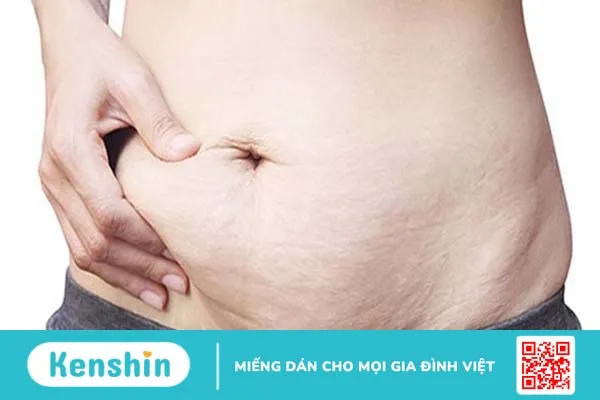 Tìm hiểu về ưu – nhược điểm của cách xóa rạn da sau sinh