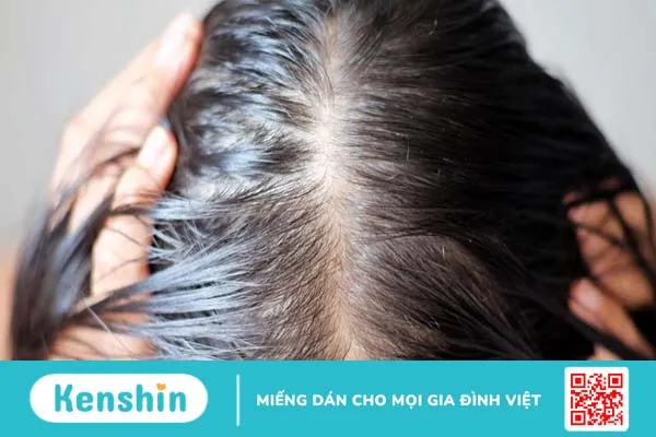 Tóc bết là gì? Làm thế nào để hạn chế tình trạng này?