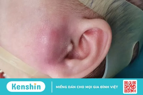 Tổng hợp những điều cần biết về nhọt ống tai ngoài