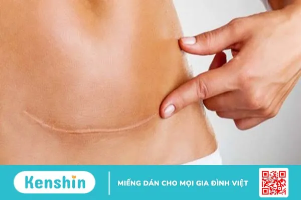 Top 18 thực đơn cho mẹ sau sinh mổ để lợi sữa, nhanh liền sẹo