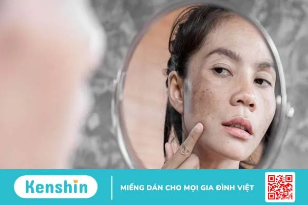 Trị đồi mồi sau sinh như thế nào?