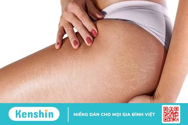 Trị rạn da mông lâu năm có hiệu quả không? Cách chữa thế nào?