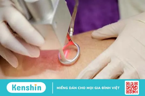 Trị rạn da sau sinh bằng laser có hiệu quả không?