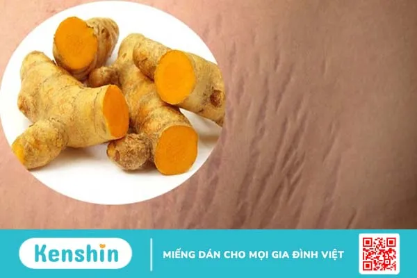 Trị rạn da sau sinh bằng nghệ tươi: Chi tiết A – Z