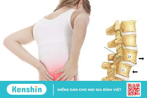 Trượt đốt sống ra trước (L4,L5) và những điều cần biết