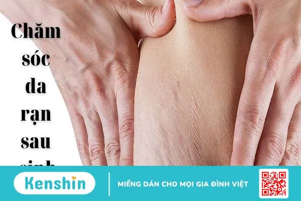 Tư vấn chăm sóc rạn da sau sinh đúng cách