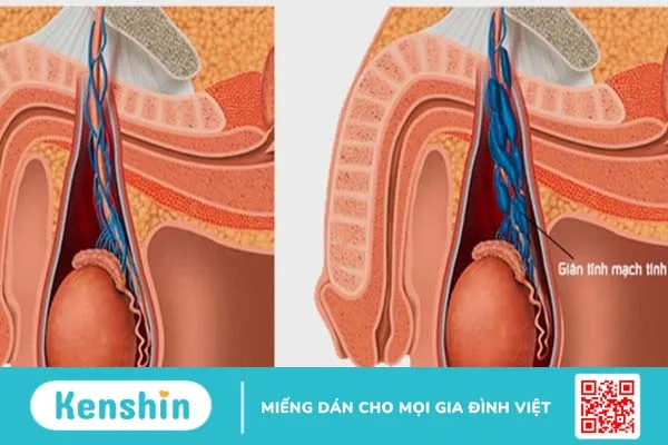 Túi giãn tĩnh mạch bìu là gì? Nguyên nhân và phương pháp điều trị