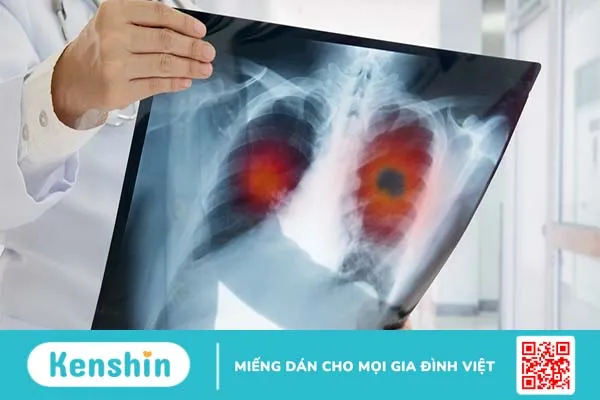 Tỷ lệ sống sót ở bệnh nhân ung thư phổi giai đoạn 4