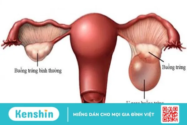 U nang buồng trứng kiêng ăn gì? Chế độ ăn phù hợp cho bệnh nhân u nang